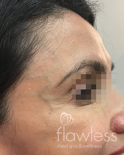 BOTOX Before & After Gallery - Patient 58202278 - Image 2