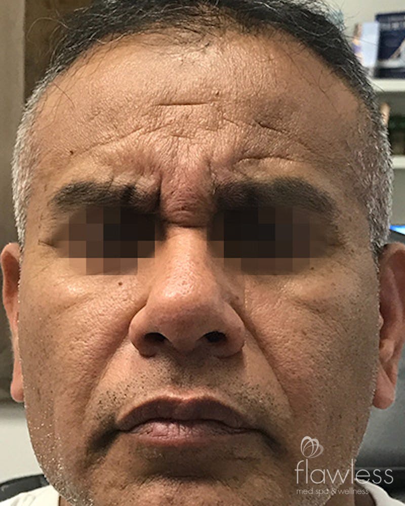 BOTOX Before & After Gallery - Patient 58202277 - Image 1