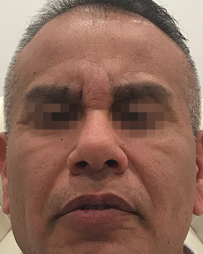 BOTOX Before & After Gallery - Patient 58202277 - Image 2