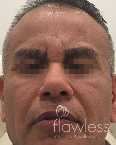 BOTOX Before & After Gallery - Patient 58202277 - Image 2