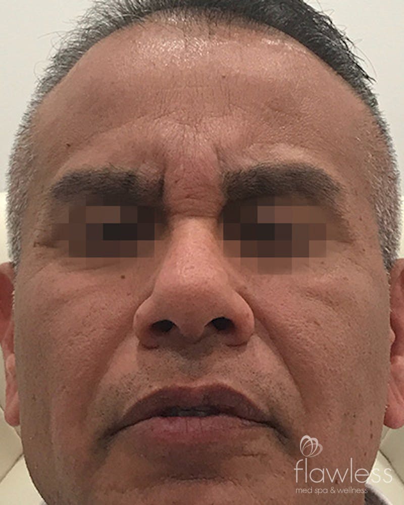 BOTOX Before & After Gallery - Patient 58202277 - Image 2