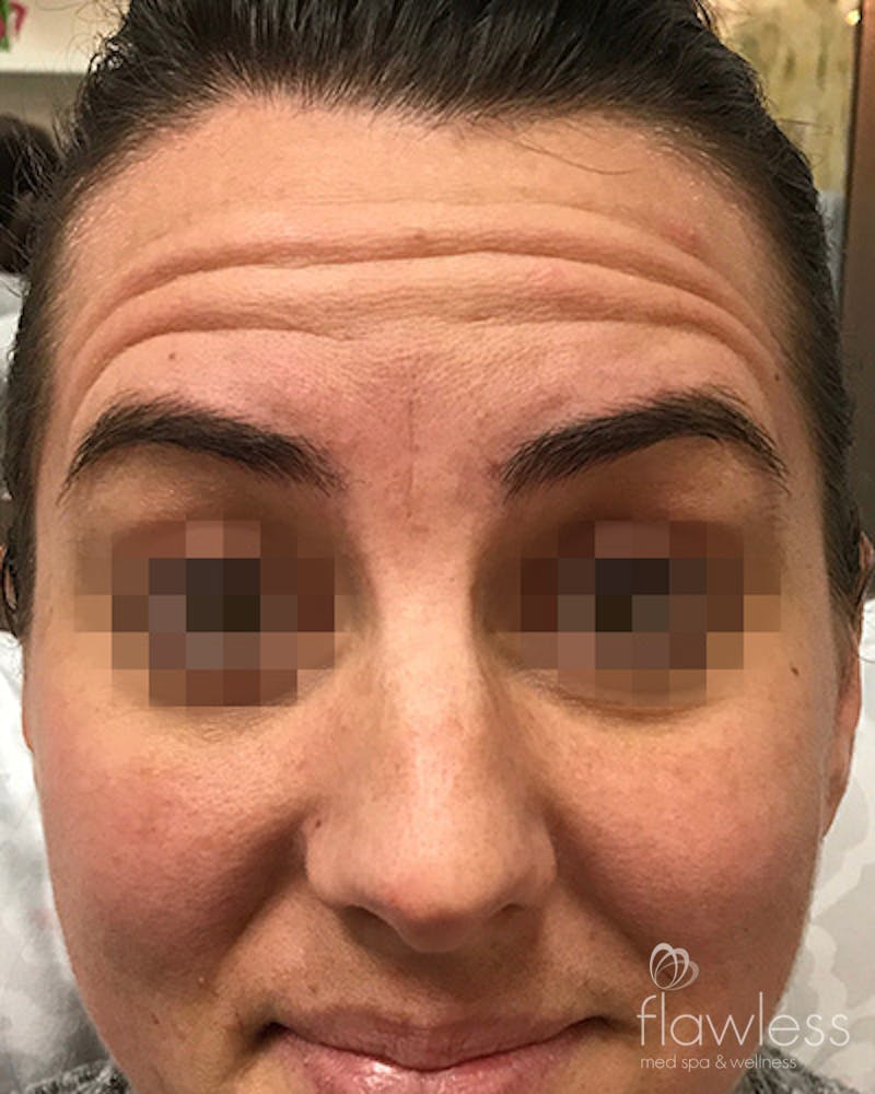 BOTOX Before & After Gallery - Patient 58202276 - Image 1