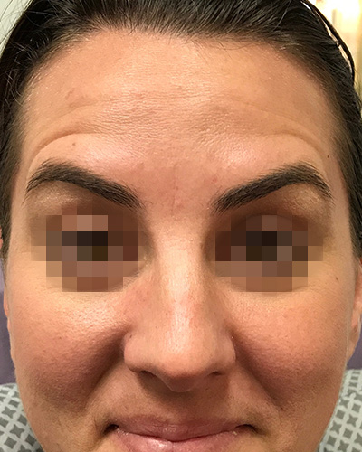 BOTOX Before & After Gallery - Patient 58202276 - Image 2