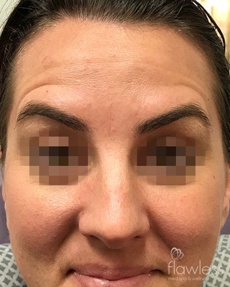 BOTOX Before & After Gallery - Patient 58202276 - Image 2