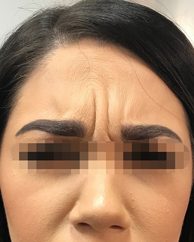 BOTOX Before & After Gallery - Patient 58202275 - Image 1