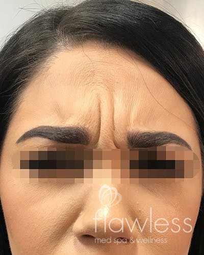 BOTOX Before & After Gallery - Patient 58202275 - Image 1