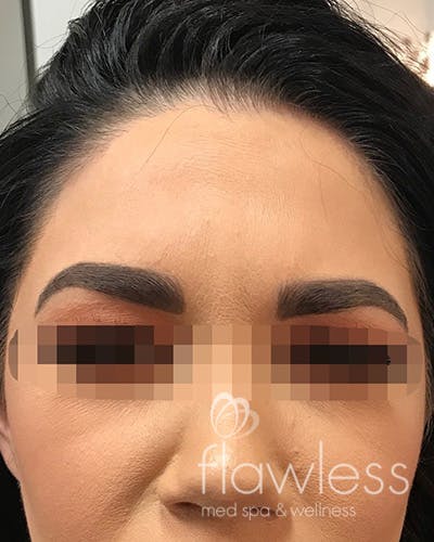 BOTOX Before & After Gallery - Patient 58202275 - Image 2