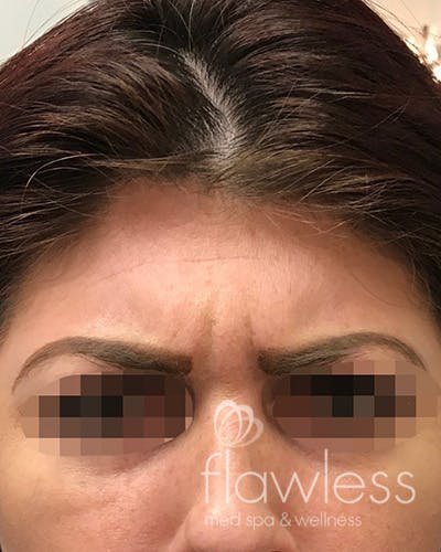 BOTOX Before & After Gallery - Patient 58202274 - Image 1