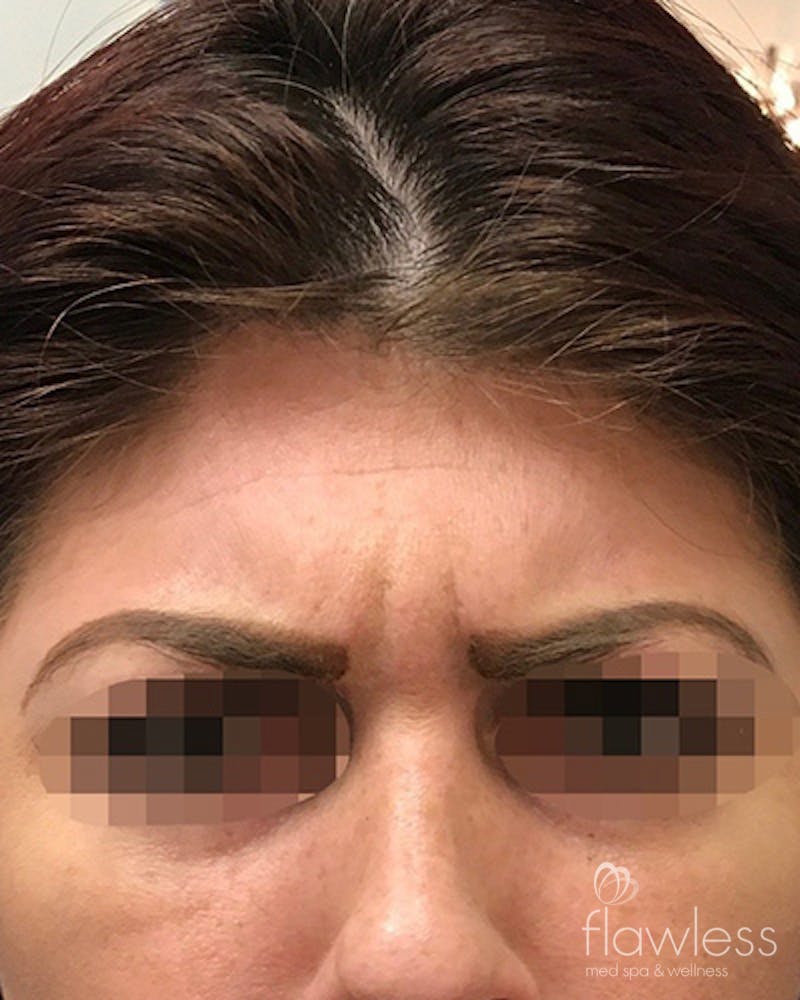 BOTOX Before & After Gallery - Patient 58202274 - Image 1