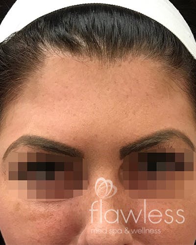 BOTOX Before & After Gallery - Patient 58202274 - Image 2