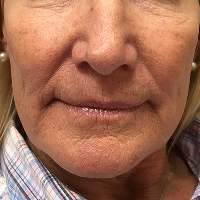 Lip Filler Before & After Gallery - Patient 58202313 - Image 1