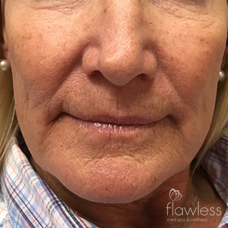 Lip Filler Before & After Gallery - Patient 58202313 - Image 1