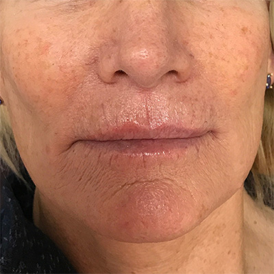 Lip Filler Before & After Gallery - Patient 58202313 - Image 2