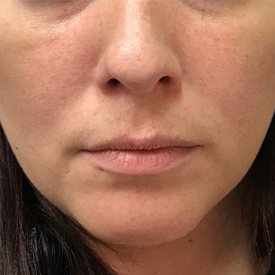 Lip Filler Before & After Gallery - Patient 58202312 - Image 1