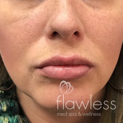 Lip Filler Before & After Gallery - Patient 58202312 - Image 2