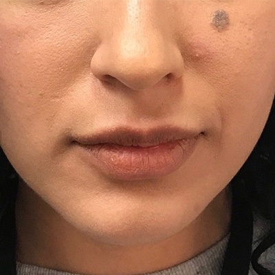 Lip Filler Before & After Gallery - Patient 58202311 - Image 1