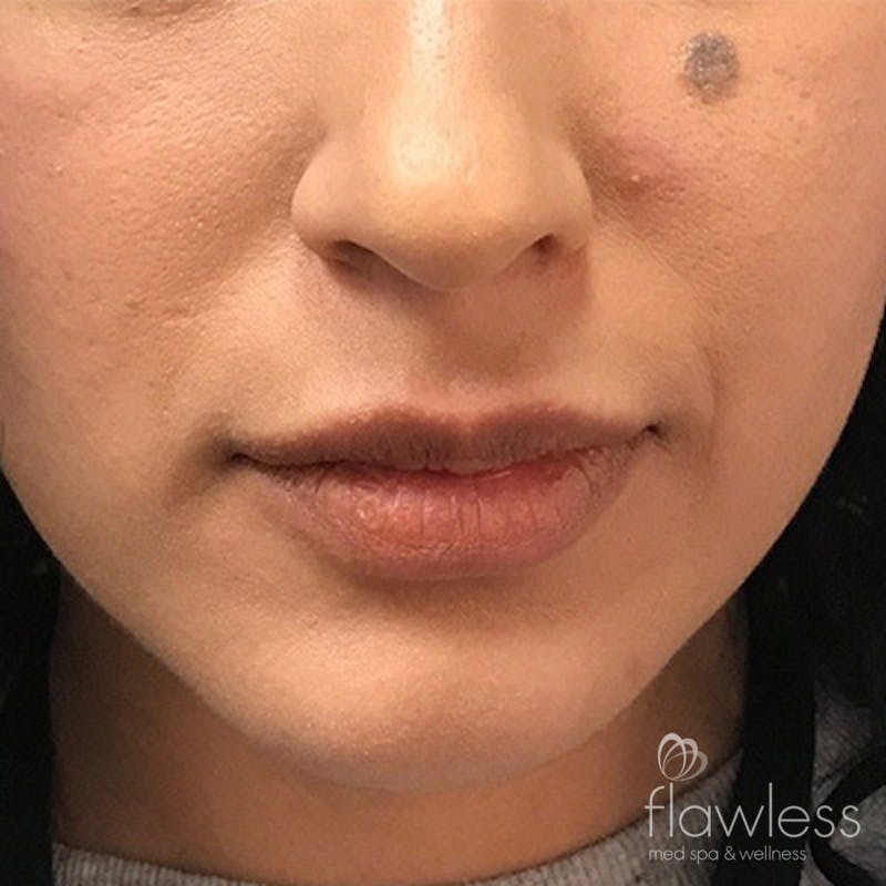 Lip Filler Before & After Gallery - Patient 58202311 - Image 1
