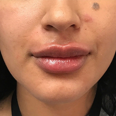 Lip Filler Before & After Gallery - Patient 58202311 - Image 2