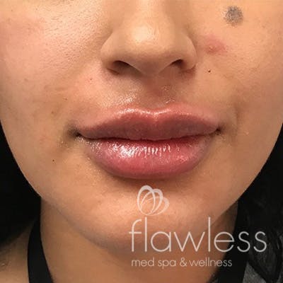 Lip Filler Before & After Gallery - Patient 58202311 - Image 2