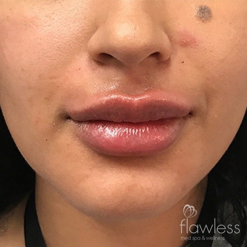 Lip Filler Before & After Gallery - Patient 58202311 - Image 2