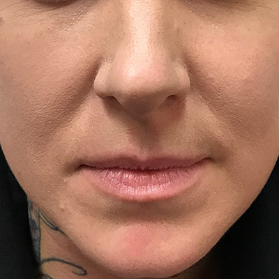 Lip Filler Before & After Gallery - Patient 58202315 - Image 1