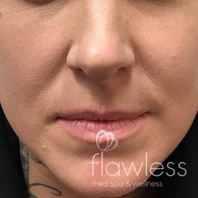 Lip Filler Before & After Gallery - Patient 58202315 - Image 1