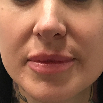 Lip Filler Before & After Gallery - Patient 58202315 - Image 2