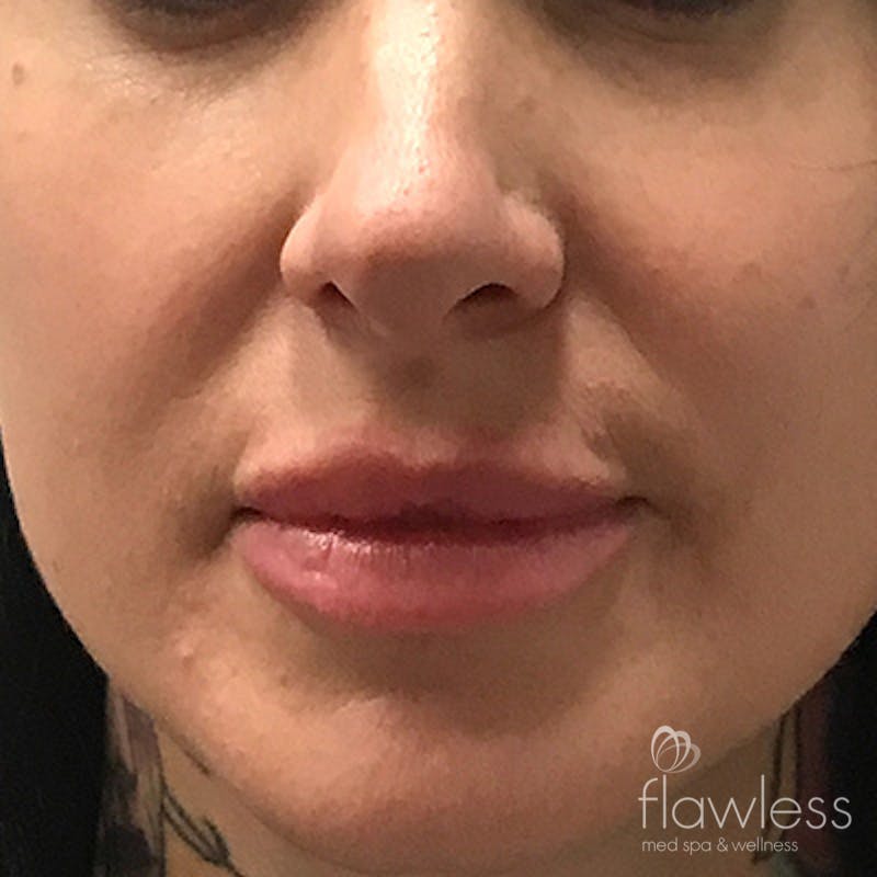 Lip Filler Before & After Gallery - Patient 58202315 - Image 2