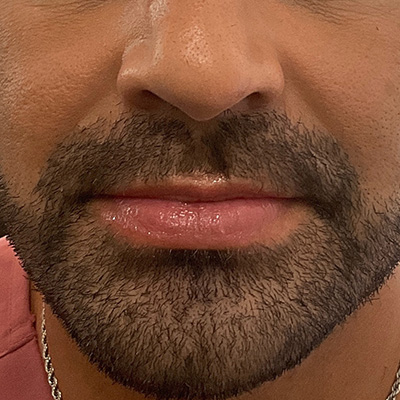 Lip Filler Before & After Gallery - Patient 58202314 - Image 1