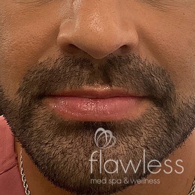 Lip Filler Before & After Gallery - Patient 58202314 - Image 1