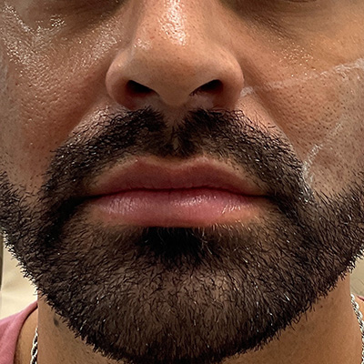 Lip Filler Before & After Gallery - Patient 58202314 - Image 2