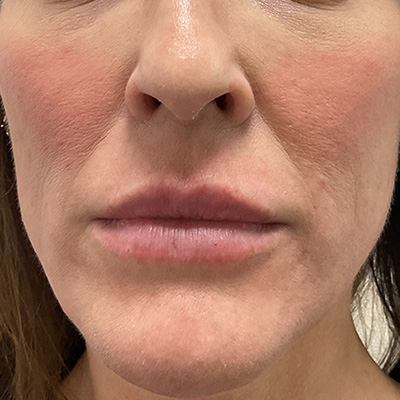Lip Filler Before & After Gallery - Patient 58202316 - Image 1