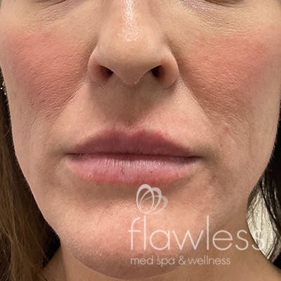 Lip Filler Before & After Gallery - Patient 58202316 - Image 1