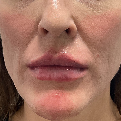 Lip Filler Before & After Gallery - Patient 58202316 - Image 2