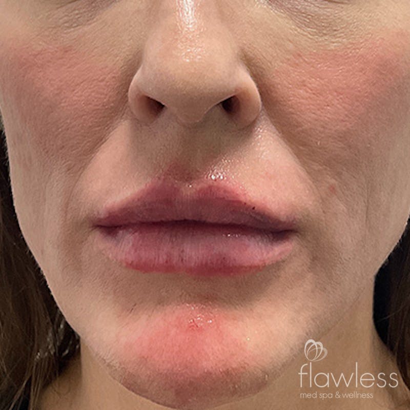 Lip Filler Before & After Gallery - Patient 58202316 - Image 2