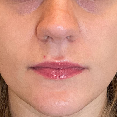 Lip Filler Before & After Gallery - Patient 58202345 - Image 1