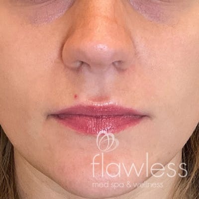 Lip Filler Before & After Gallery - Patient 58202345 - Image 1