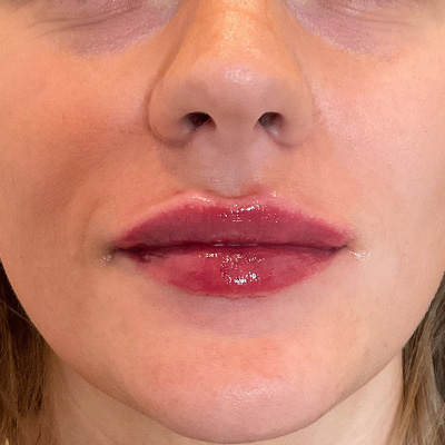 Lip Filler Before & After Gallery - Patient 58202345 - Image 2