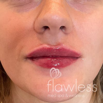 Lip Filler Before & After Gallery - Patient 58202345 - Image 2