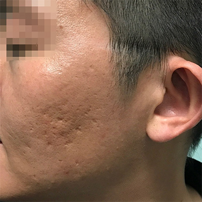 Acne Scar Repair Before & After Gallery - Patient 58202359 - Image 1
