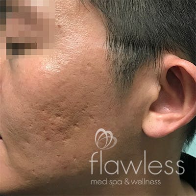 Acne Scar Repair Before & After Gallery - Patient 58202359 - Image 1