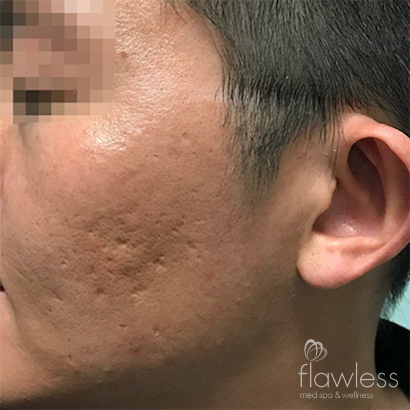 Acne Scar Repair Before & After Gallery - Patient 58202359 - Image 1
