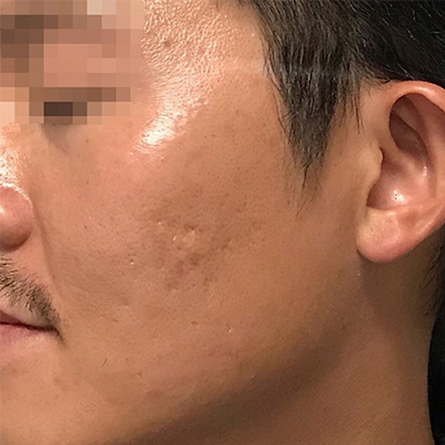 Acne Scar Repair Before & After Gallery - Patient 58202359 - Image 2