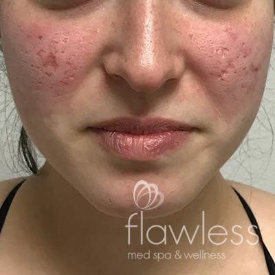 Acne Scar Repair Before & After Gallery - Patient 58202358 - Image 1