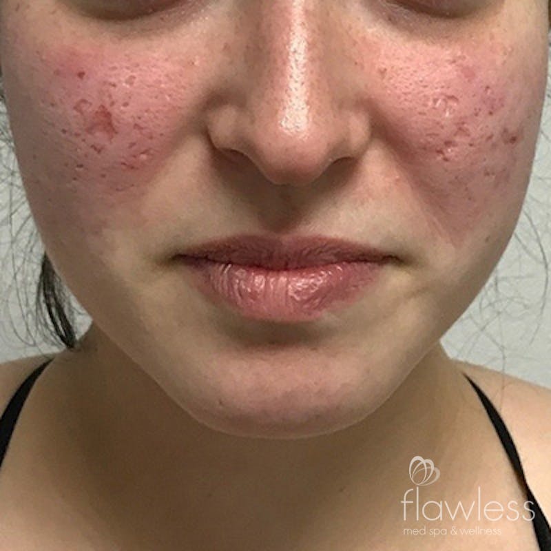 Acne Scar Repair Before & After Gallery - Patient 58202358 - Image 1