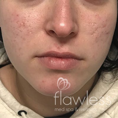 Acne Scar Repair Before & After Gallery - Patient 58202358 - Image 2
