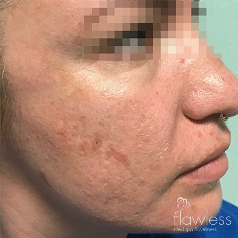 Acne Scar Repair Before & After Gallery - Patient 58202357 - Image 1
