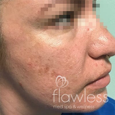 Acne Scar Repair Before & After Gallery - Patient 58202357 - Image 1