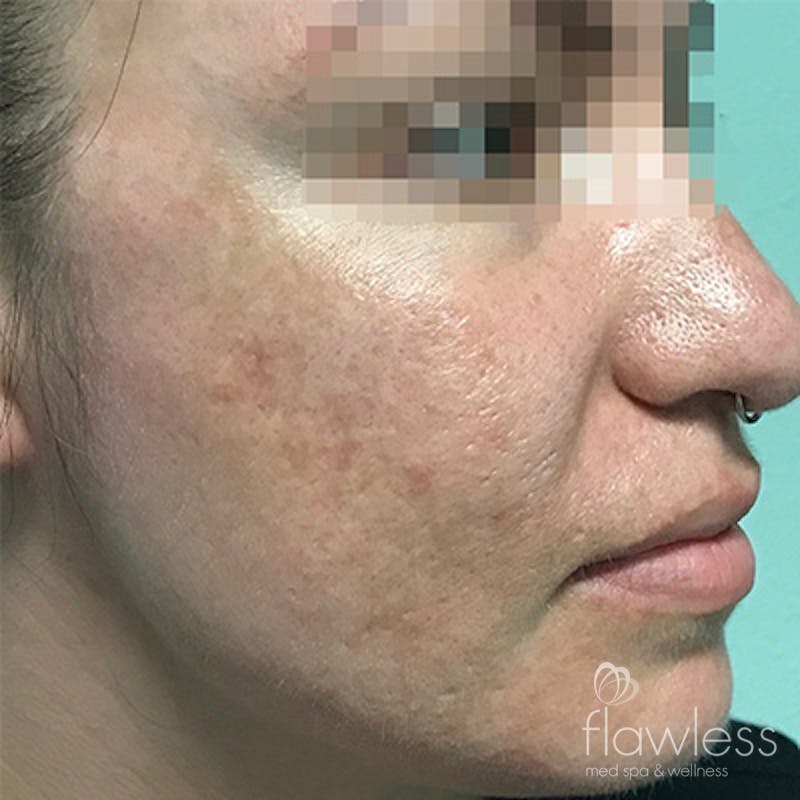 Acne Scar Repair Before & After Gallery - Patient 58202357 - Image 2