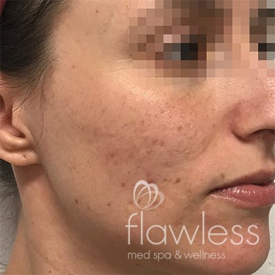 Acne Scar Repair Before & After Gallery - Patient 58202356 - Image 1